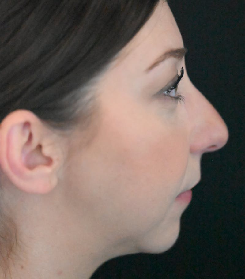 Chin Augmentation Before & After Gallery - Patient 106441117 - Image 6