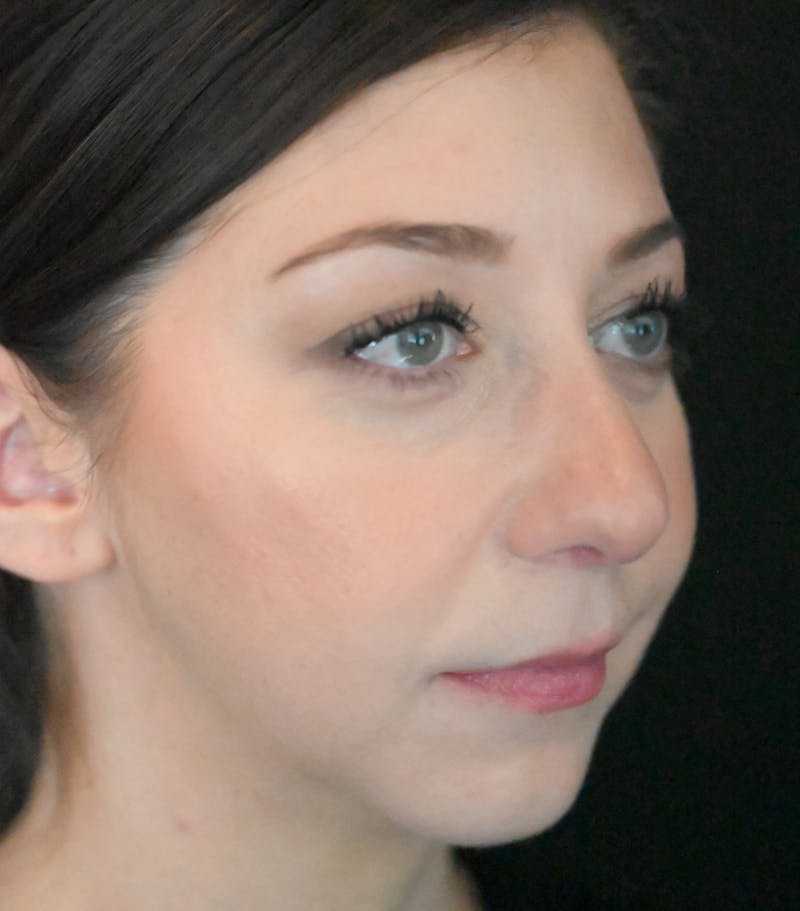 Chin Augmentation Before & After Gallery - Patient 106441117 - Image 8