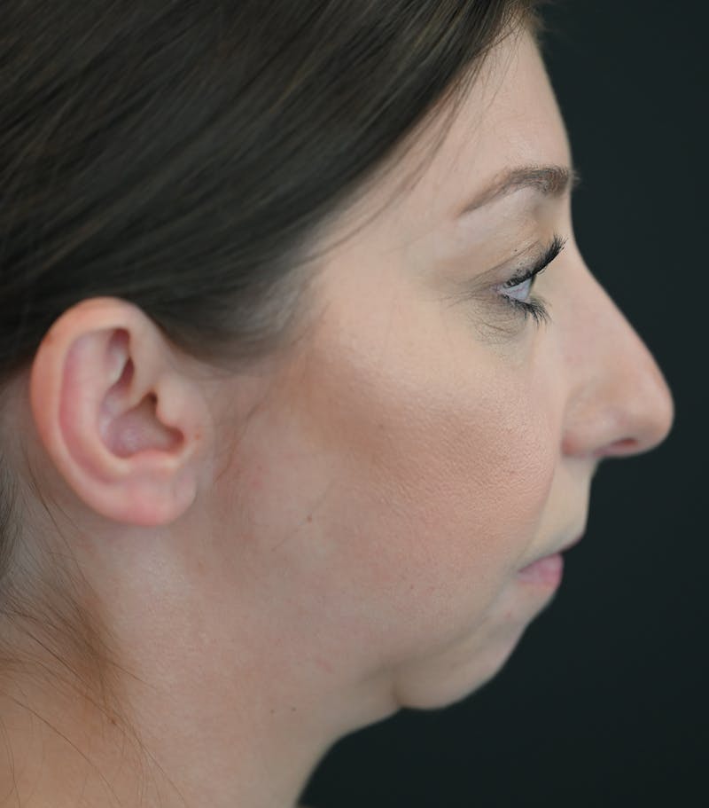 Chin Augmentation Before & After Gallery - Patient 106441117 - Image 5