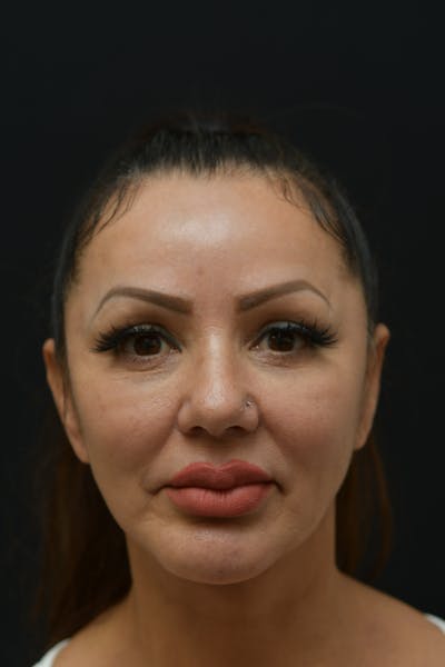 Facial Rejuvenation Before & After Gallery - Patient 106441148 - Image 2
