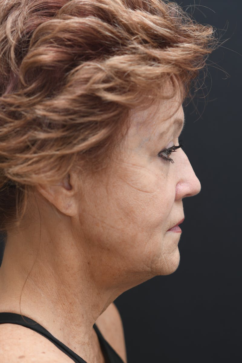 Facial Rejuvenation Before & After Gallery - Patient 106441147 - Image 7