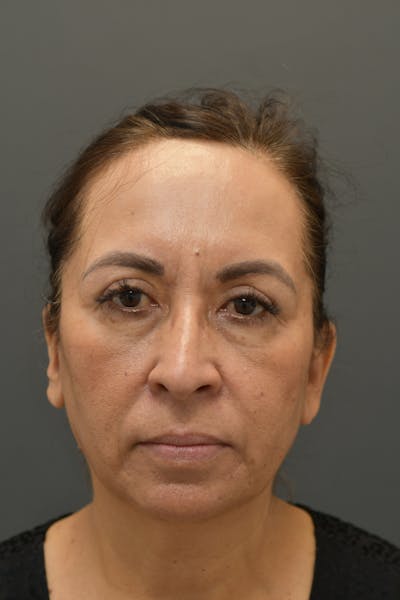 Facial Rejuvenation Before & After Gallery - Patient 106441184 - Image 2