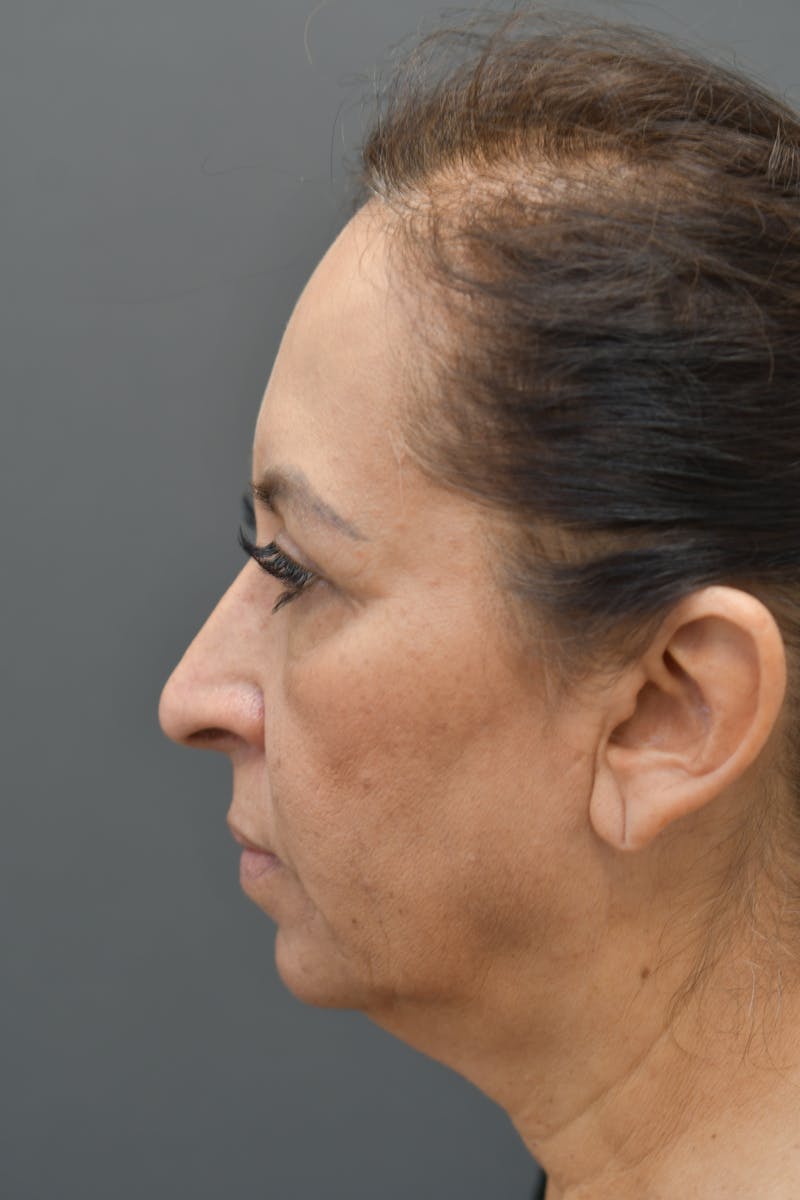 Facial Rejuvenation Before & After Gallery - Patient 106441184 - Image 4