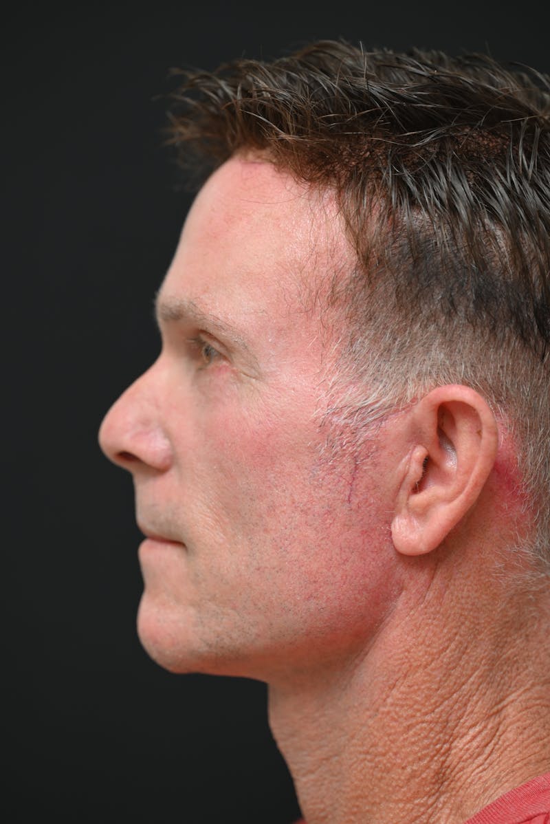 Facial Rejuvenation Before & After Gallery - Patient 106441203 - Image 4