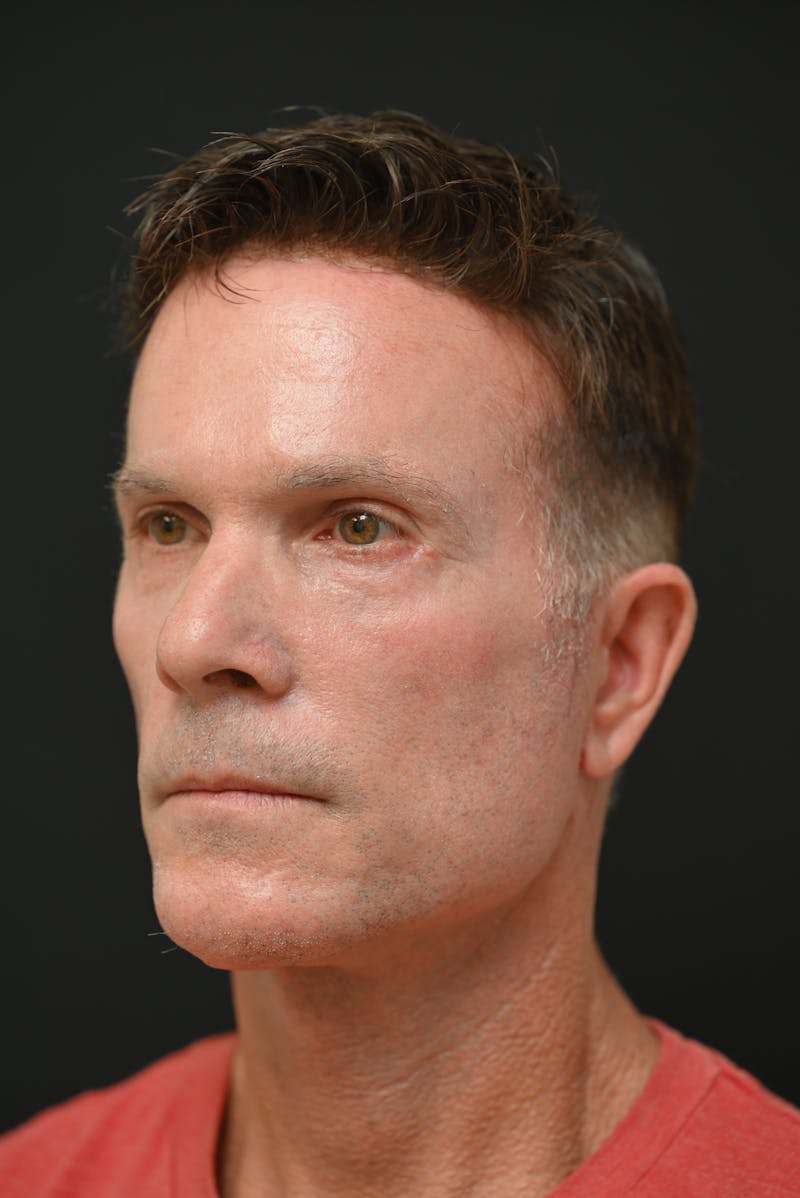 Facial Rejuvenation Before & After Gallery - Patient 106441203 - Image 6