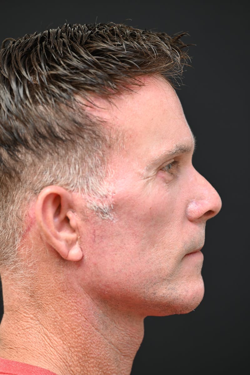 Facial Rejuvenation Before & After Gallery - Patient 106441203 - Image 8