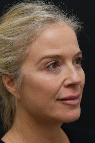 Facial Rejuvenation Before & After Gallery - Patient 106441210 - Image 2