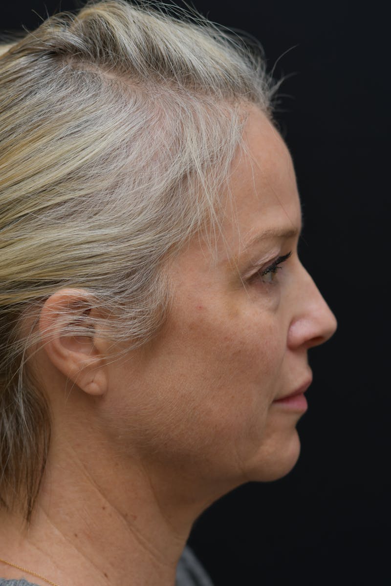 Facial Rejuvenation Before & After Gallery - Patient 106441210 - Image 3