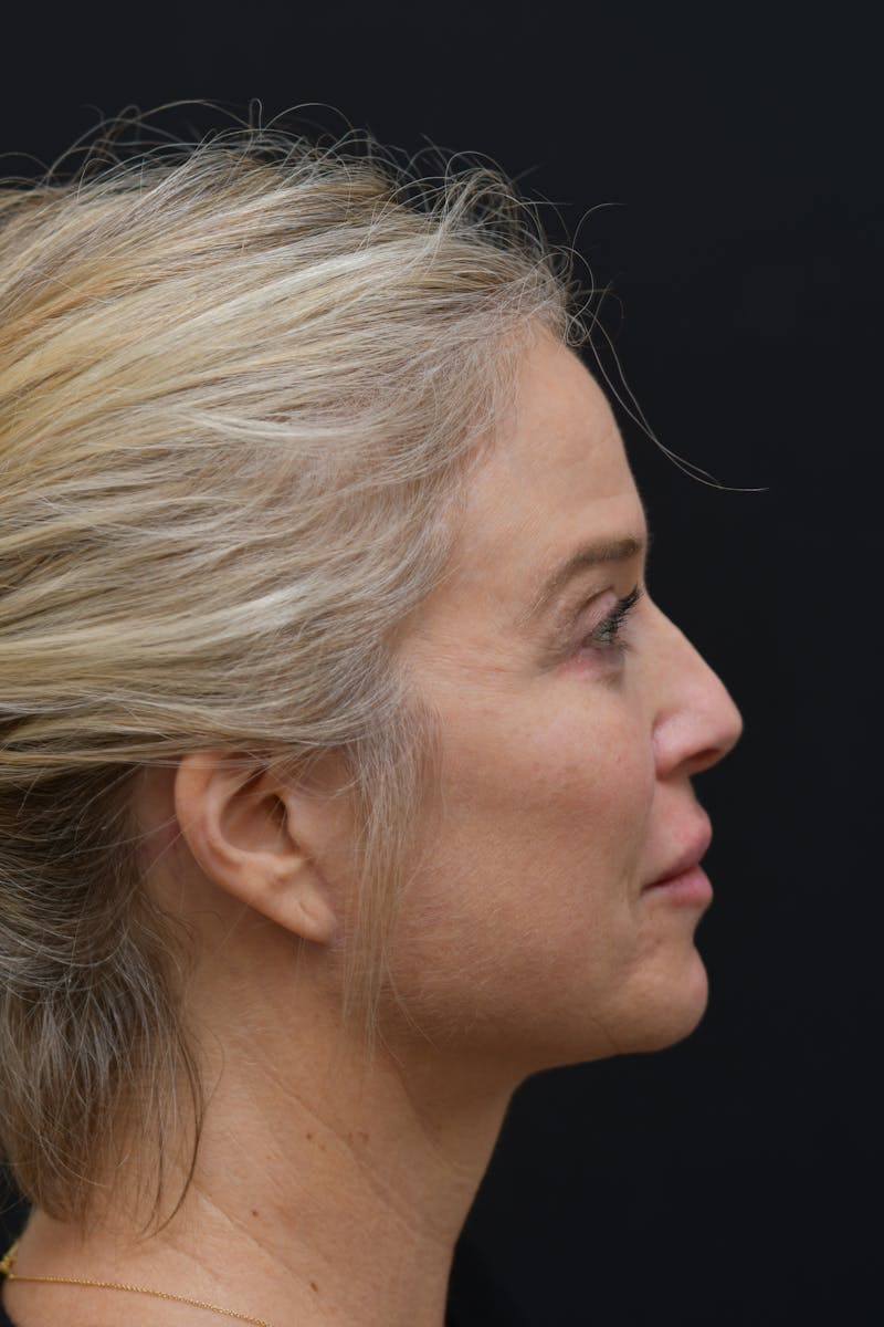 Facial Rejuvenation Before & After Gallery - Patient 106441210 - Image 4