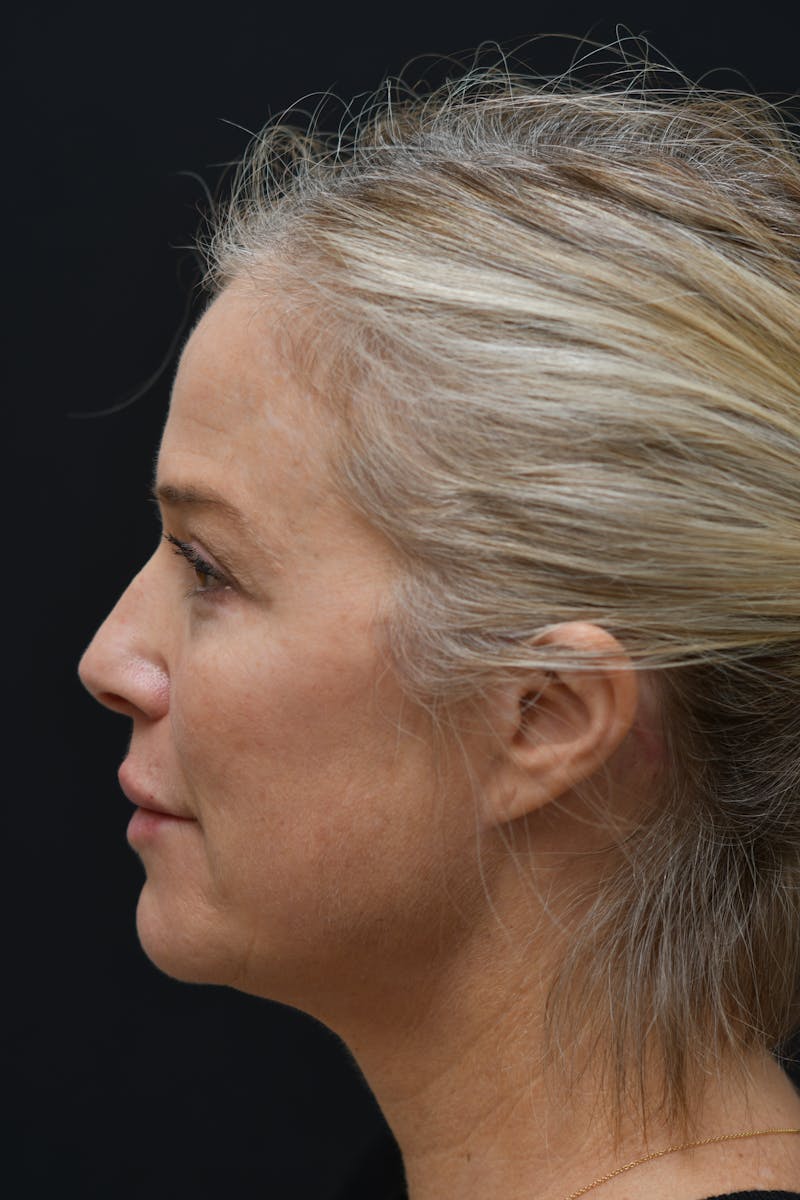 Facial Rejuvenation Before & After Gallery - Patient 106441210 - Image 8