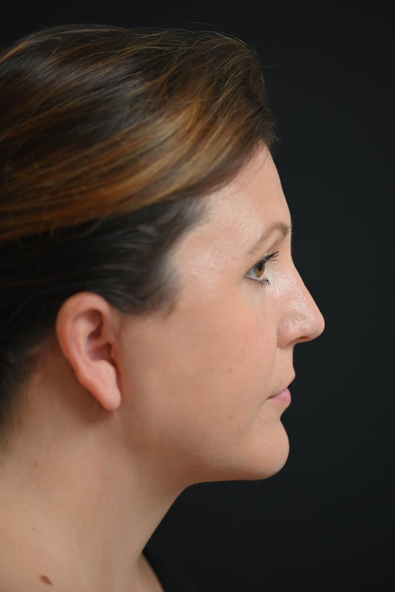 Facial Rejuvenation Before & After Gallery - Patient 106441211 - Image 6