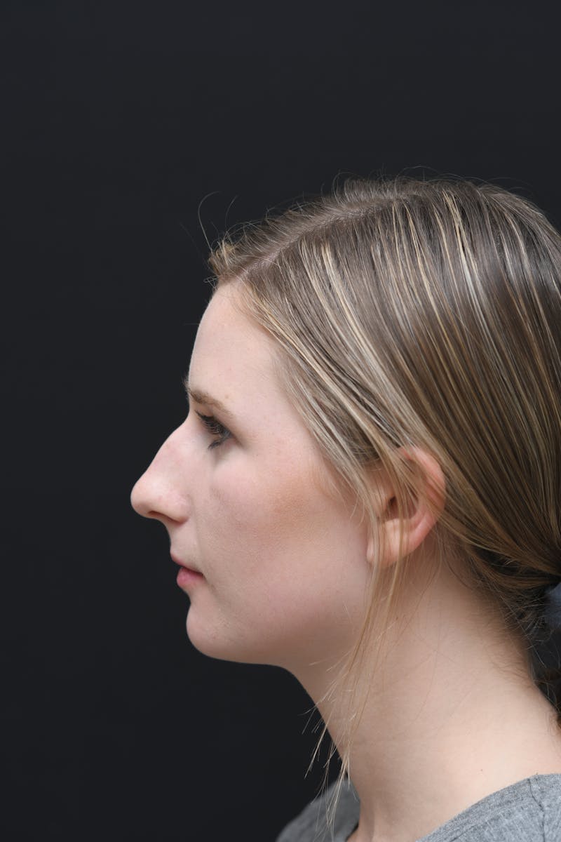 Rhinoplasty Before & After Gallery - Patient 106441225 - Image 1