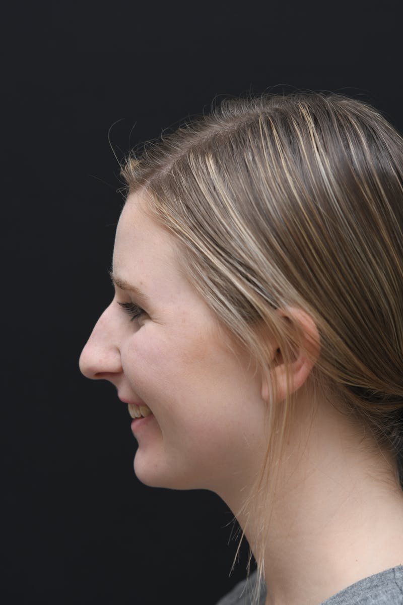 Rhinoplasty Before & After Gallery - Patient 106441225 - Image 3