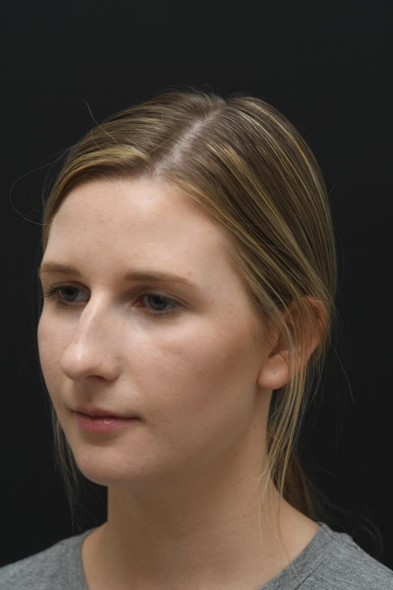 Rhinoplasty Before & After Gallery - Patient 106441225 - Image 5