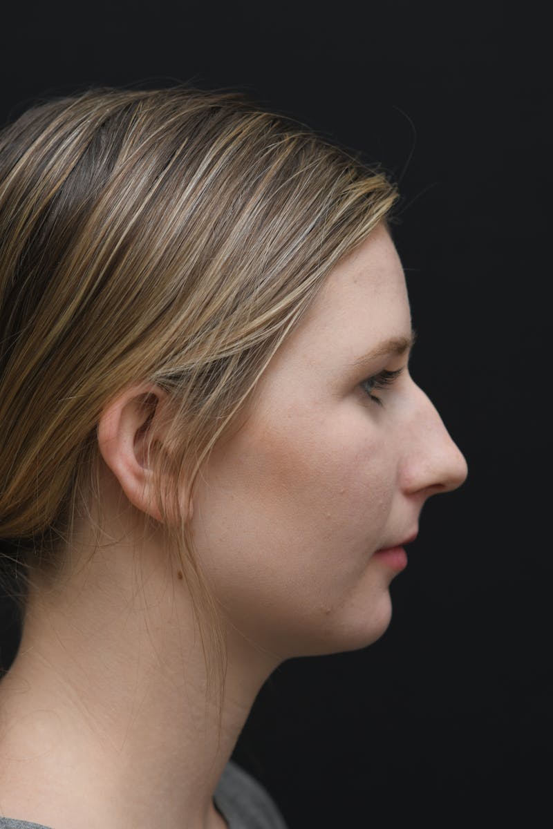 Rhinoplasty Before & After Gallery - Patient 106441225 - Image 9