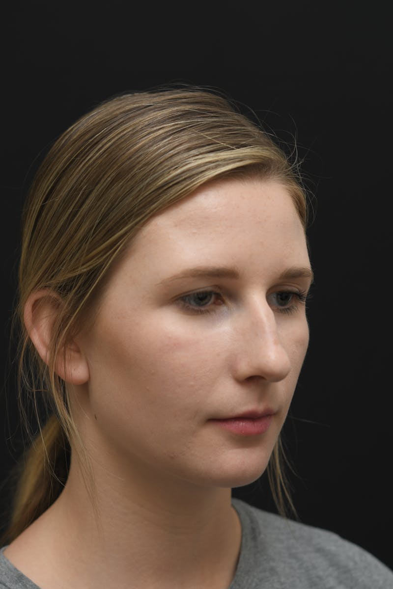 Rhinoplasty Before & After Gallery - Patient 106441225 - Image 11