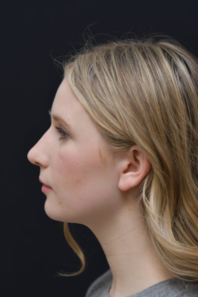 Rhinoplasty Before & After Gallery - Patient 106441225 - Image 2
