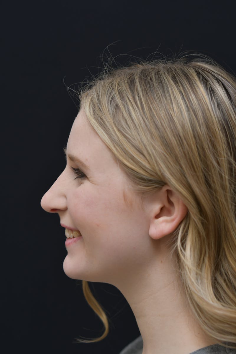 Rhinoplasty Before & After Gallery - Patient 106441225 - Image 4