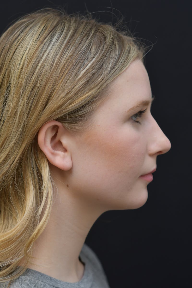 Rhinoplasty Before & After Gallery - Patient 106441225 - Image 10