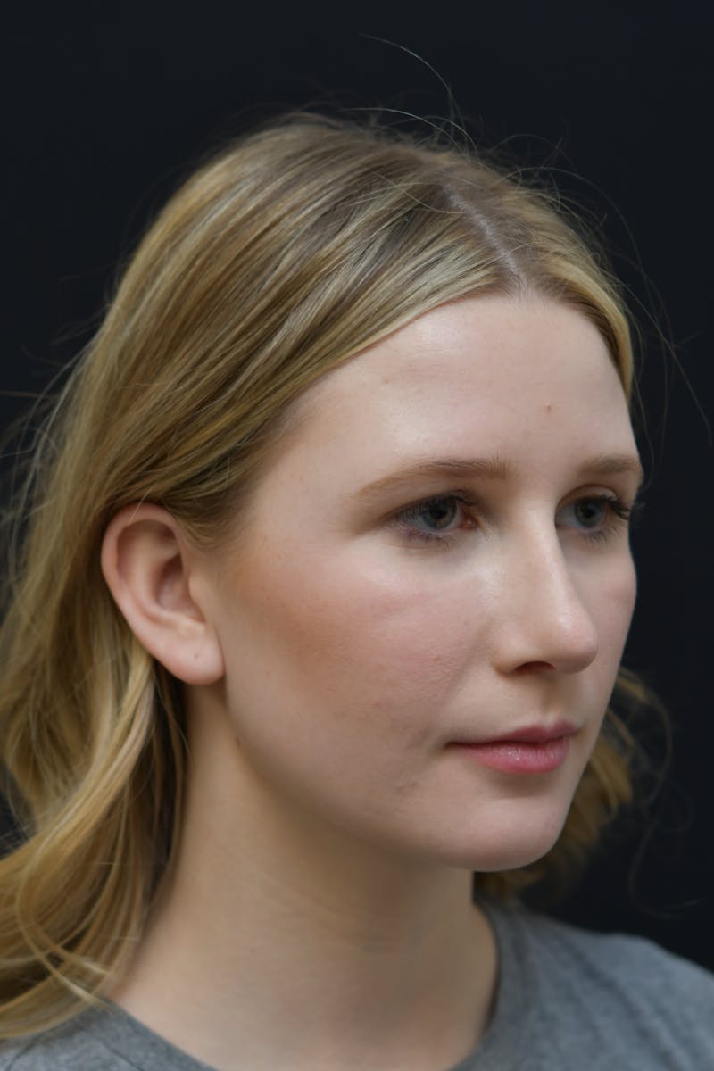 Rhinoplasty Before & After Gallery - Patient 106441225 - Image 12