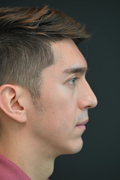 Rhinoplasty Before & After Gallery - Patient 106441261 - Image 2