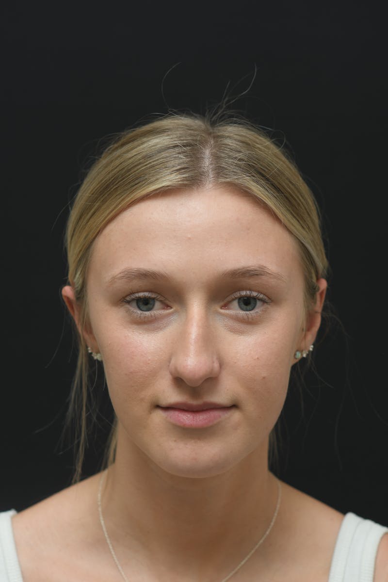 Rhinoplasty Before & After Gallery - Patient 106441262 - Image 3