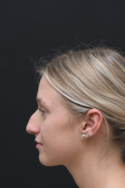Rhinoplasty Before & After Gallery - Patient 106441262 - Image 1