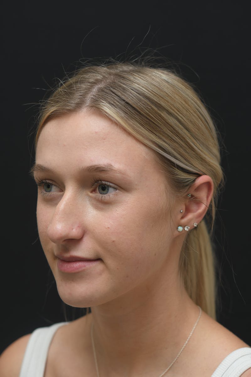 Rhinoplasty Before & After Gallery - Patient 106441262 - Image 5
