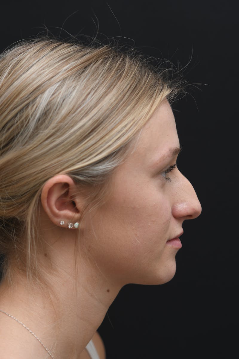 Rhinoplasty Before & After Gallery - Patient 106441262 - Image 7