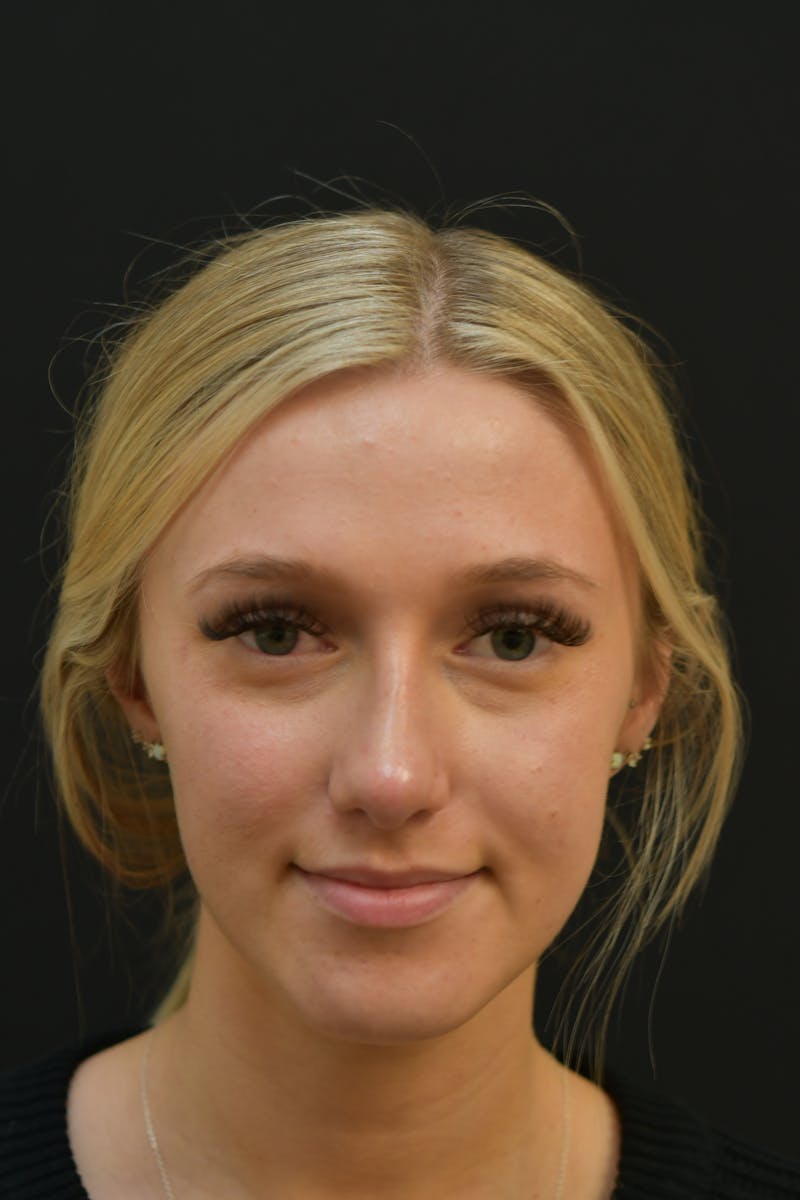 Rhinoplasty Before & After Gallery - Patient 106441262 - Image 4