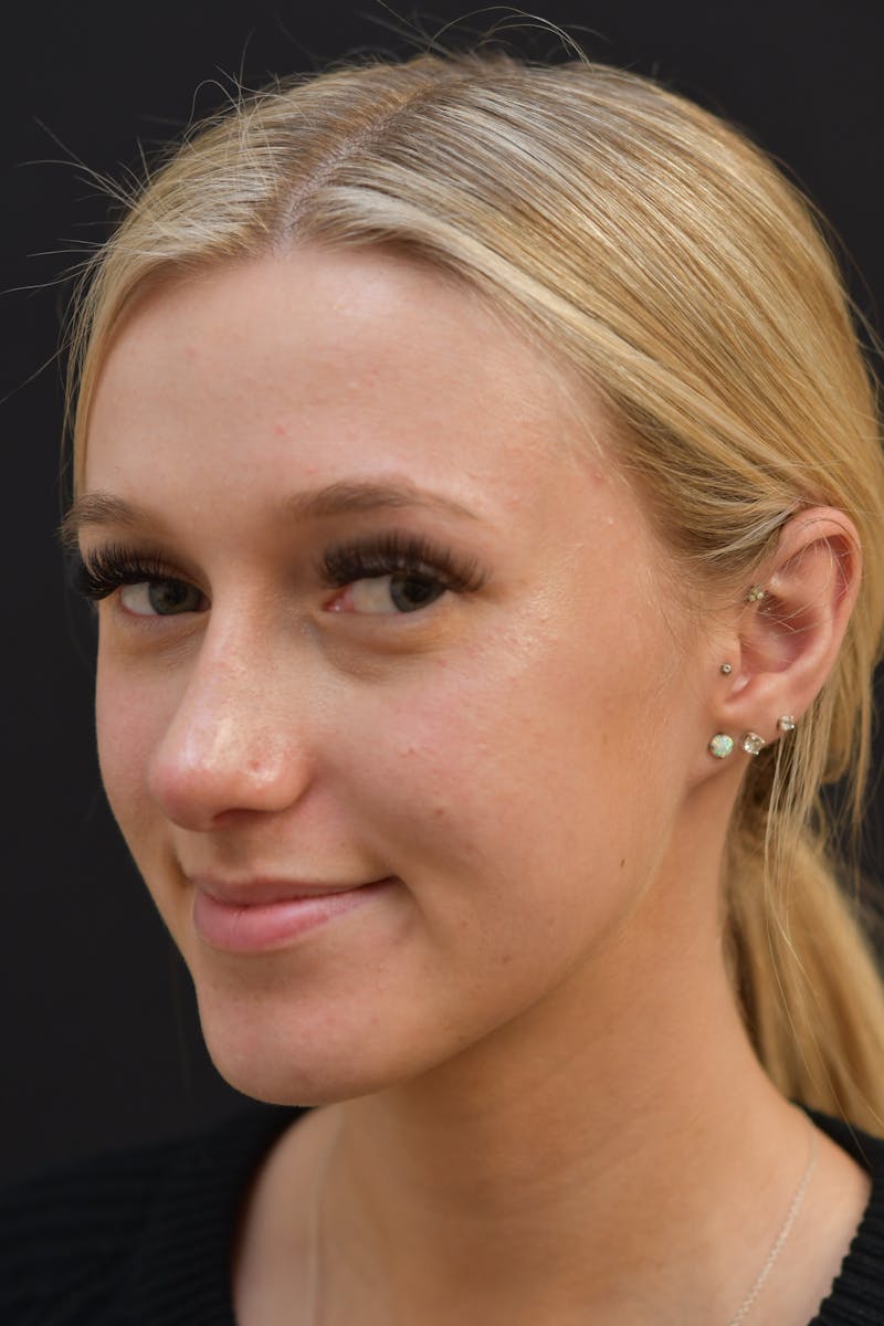 Rhinoplasty Before & After Gallery - Patient 106441262 - Image 6