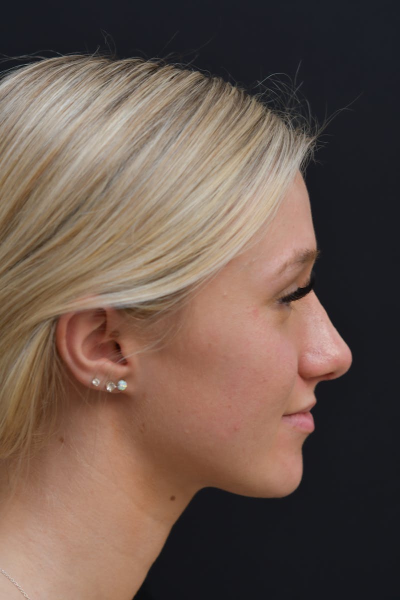 Rhinoplasty Before & After Gallery - Patient 106441262 - Image 8