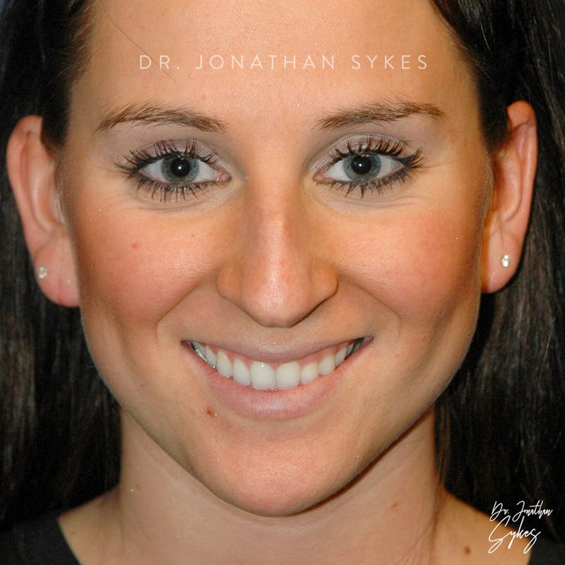 Rhinoplasty Before & After Gallery - Patient 106441271 - Image 1