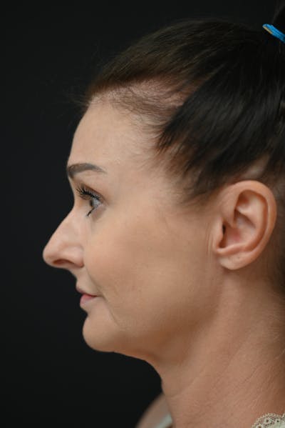 Rhinoplasty Before & After Gallery - Patient 106441272 - Image 1