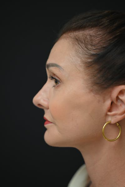 Rhinoplasty Before & After Gallery - Patient 106441272 - Image 2