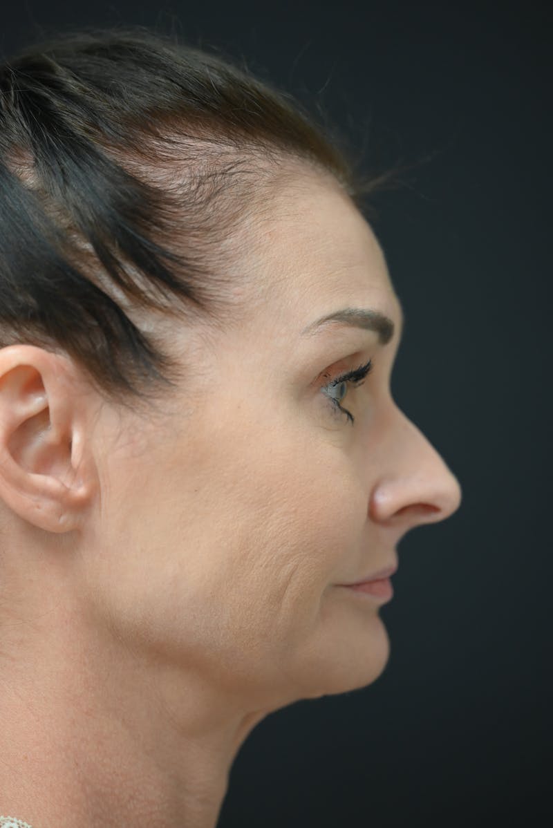 Rhinoplasty Before & After Gallery - Patient 106441272 - Image 7