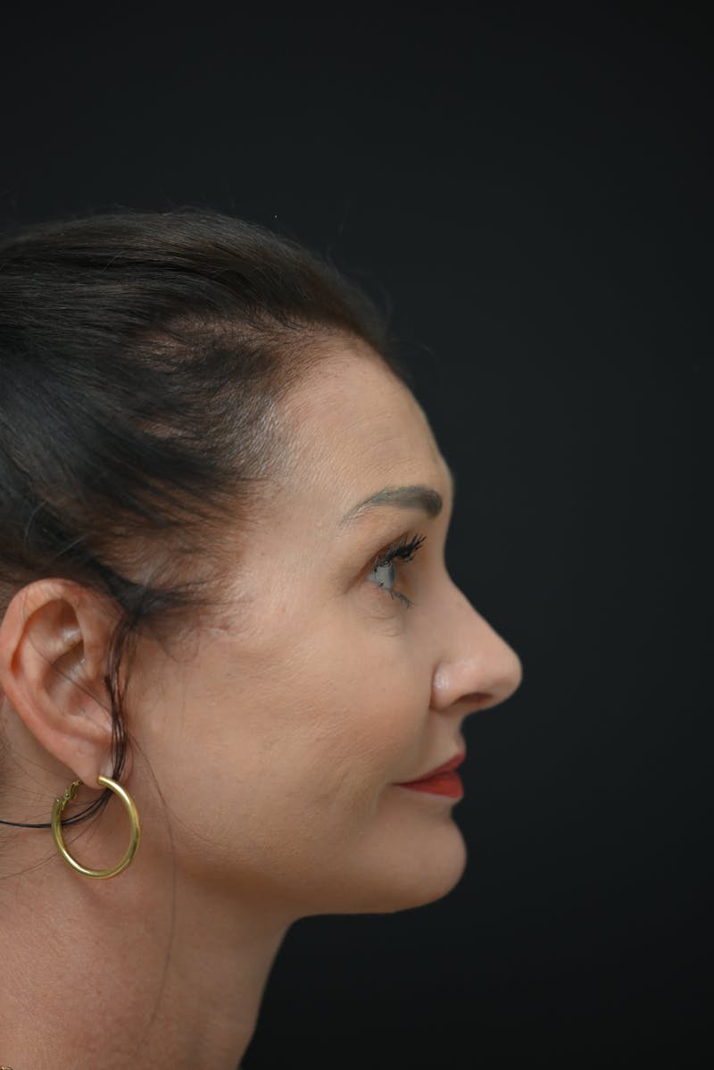 Rhinoplasty Before & After Gallery - Patient 106441272 - Image 8