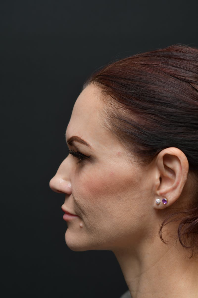Rhinoplasty Before & After Gallery - Patient 106441273 - Image 3