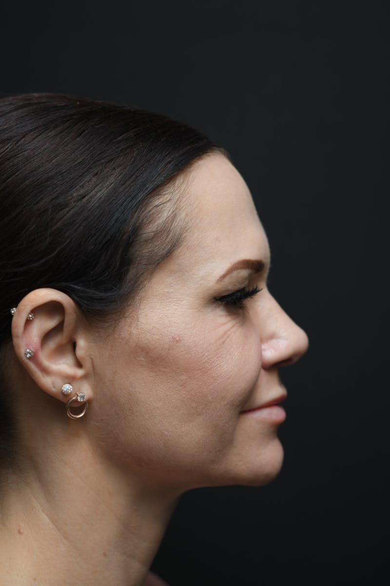 Rhinoplasty Before & After Gallery - Patient 106441273 - Image 8