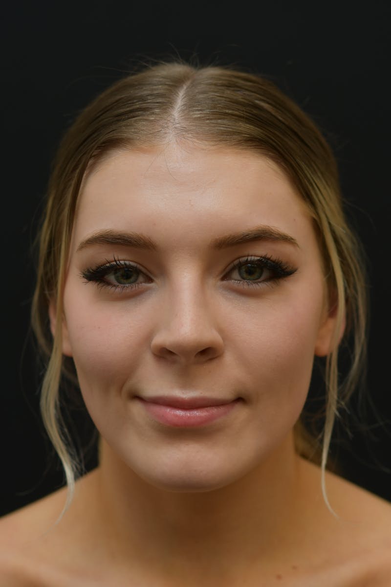 Rhinoplasty Before & After Gallery - Patient 106441320 - Image 4