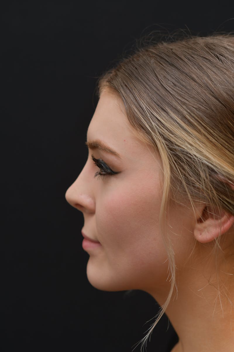 Rhinoplasty Before & After Gallery - Patient 106441320 - Image 2