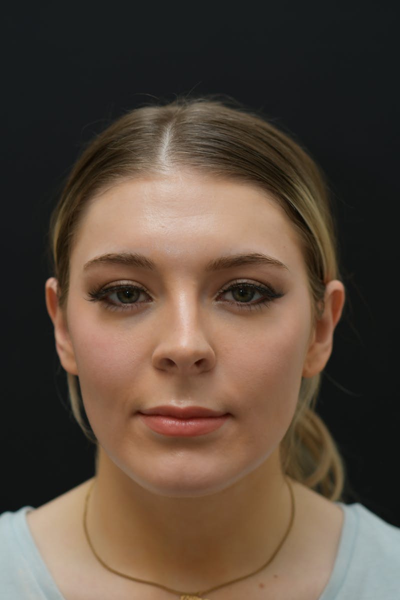 Rhinoplasty Before & After Gallery - Patient 106441320 - Image 3