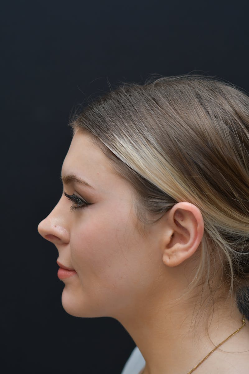 Rhinoplasty Before & After Gallery - Patient 106441320 - Image 1