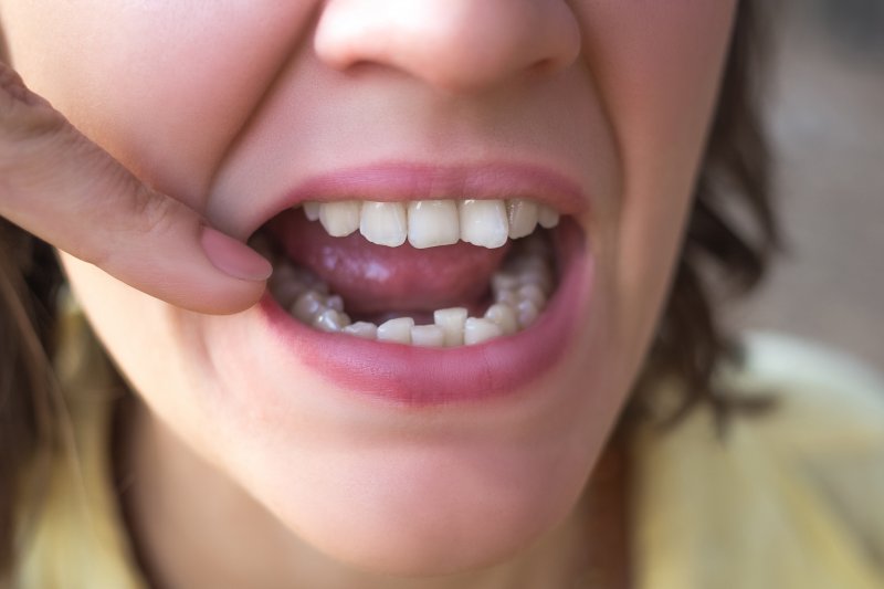 Causes Of Teeth Shifting Trophy Club Dentist David CrumptonDavid causes-of-teeth-shifting-trophy-club-dentist-david-crumptondavid