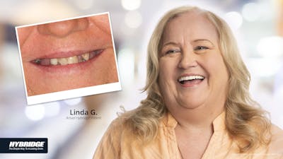 Smile Makeovers Before & After Gallery - Patient 93780847 - Image 1