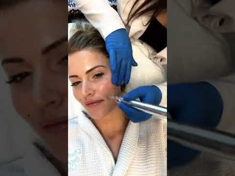 woman getting microneedling procedure