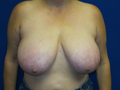 Breast Reduction Before & After Gallery - Patient 87551509 - Image 1