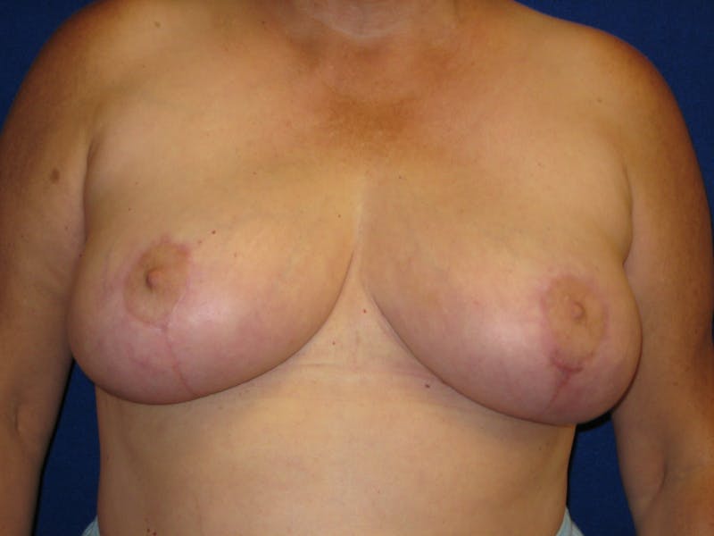 Breast Reduction Before & After Gallery - Patient 87551509 - Image 2