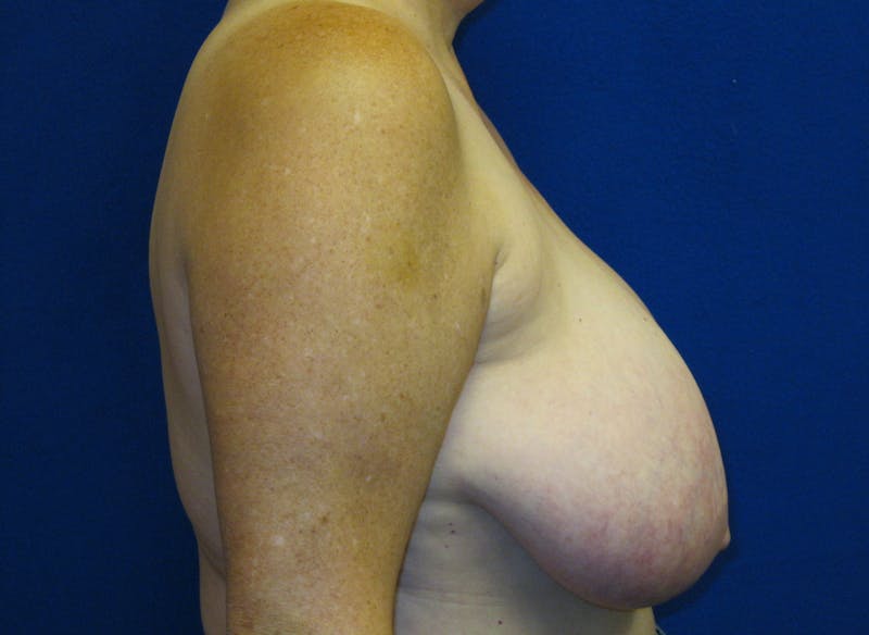 Breast Reduction Before & After Gallery - Patient 87551509 - Image 3