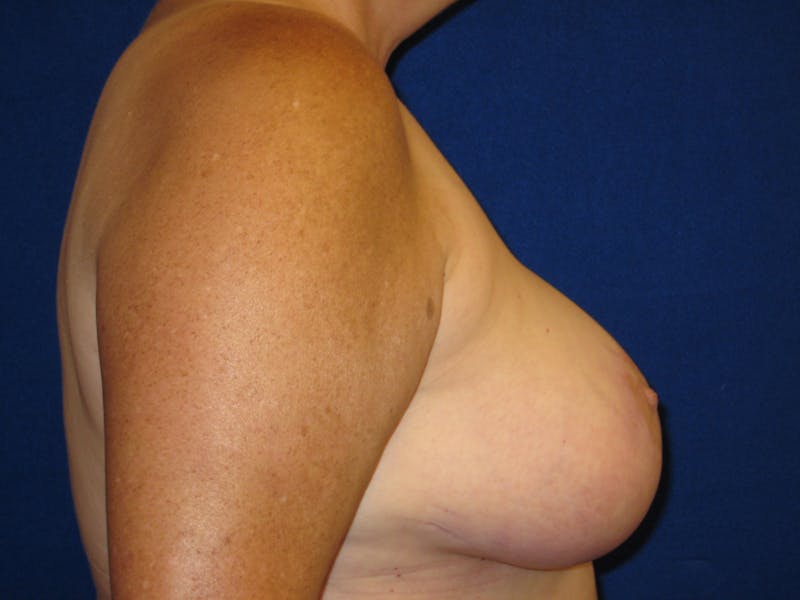 Breast Reduction Before & After Gallery - Patient 87551509 - Image 4